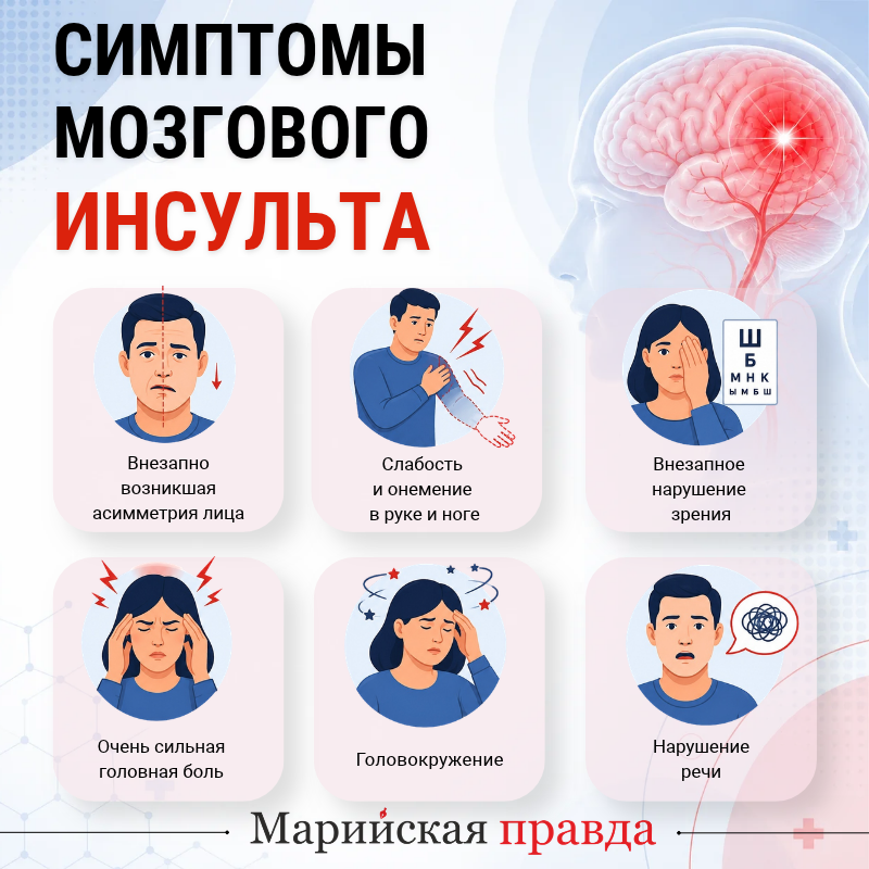 Симптомы мозгового инсульта Симптомы мозгового инсульта